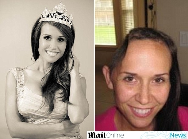 Jovem renasce aps sofrer acidente e ter crnio retirado de seu crebro