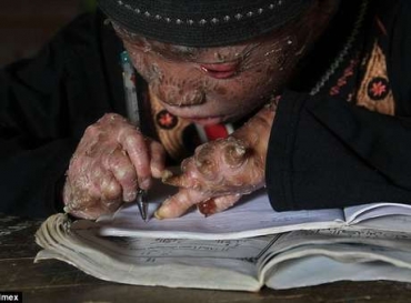 Menino tem uma doena rara que causa inflamao na pele do corpo inteiro