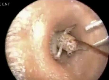 O grilo de 7 cent�metros estava vivo dentro do ouvido do homem