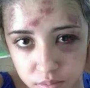 Jovem diz que foi agredida por ex que no aceitou o trmino