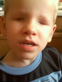 Menino afirma que a troca da bengala pelo bast�o atrapalha na sua locomo��o