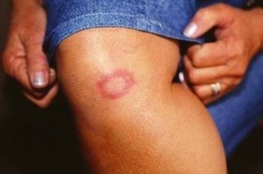 Essa  a 10 edio da campanha que conscientiza as pessoas sobre a discriminao que os portadores da doena ainda sofrem