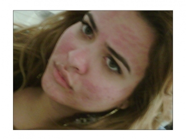 Tratamento de beleza que queimou o rosto da humorista Geisy Arruda custou R$ 700