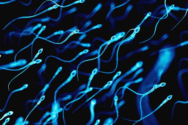 De acordo com Ajay Nangia, especialista em infertilidade masculina, a contagem normal de espermatozoides diminuiu nas últimas décadas. Fatores como tipo de alimentação, stress e falta de sono podem contribuir para essa redução e dificultar a desejada