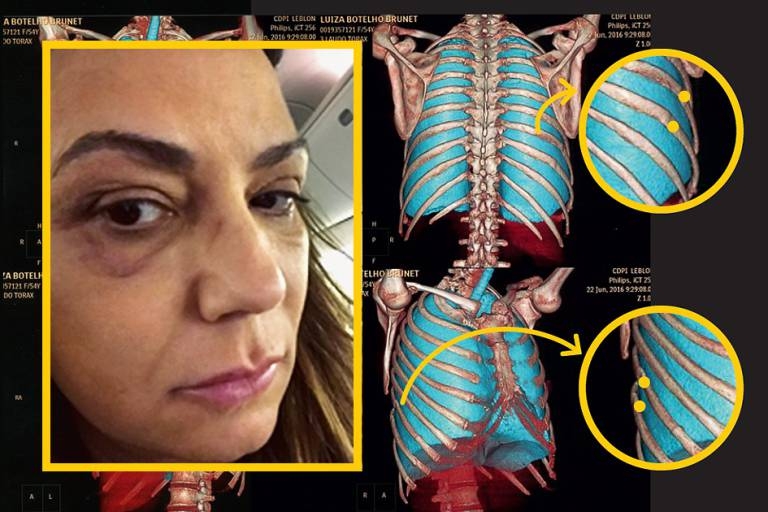 A tomografia in�dita confirma: sim, Luiza teve quatro costelas quebradas