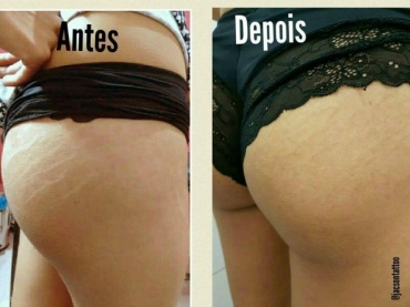 Tcnica feita por tatuador em Cuiab ajuda a disfarar estrias (Foto: Jacson de Andrade/Arquivo pessoal)