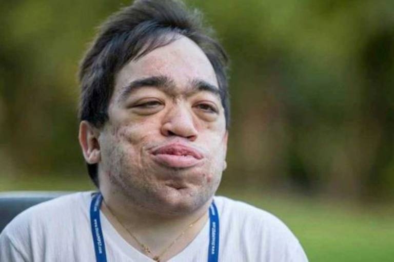 Luis Eduardo Próspero  portador de um tipo raro de mucopolissacaridose (MPS), doena gentica que impede o processamento de molculas de acar (Foto/Divulgao)