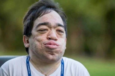 Luis Eduardo Próspero  portador de um tipo raro de mucopolissacaridose (MPS), doena gentica que impede o processamento de molculas de acar (Foto/Divulgao)