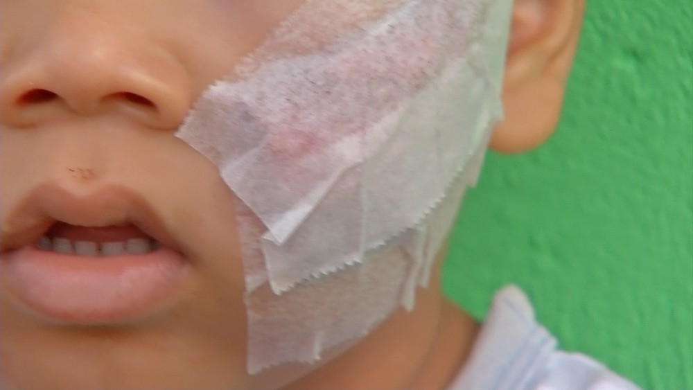 Criana ficou ferida no rosto  Foto: TVCA/ Reproduo