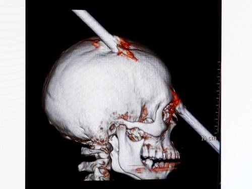 Imagem mostra vergalho que atingiu o crnio do operrio Eduardo Leite