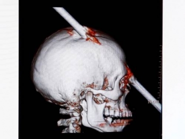 Imagem mostra vergalho que atingiu o crnio do operrio Eduardo Leite