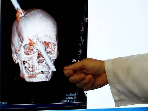 Imagem mostra vergalho do crnio de um operrio, que sobreviveu aps cirurgia