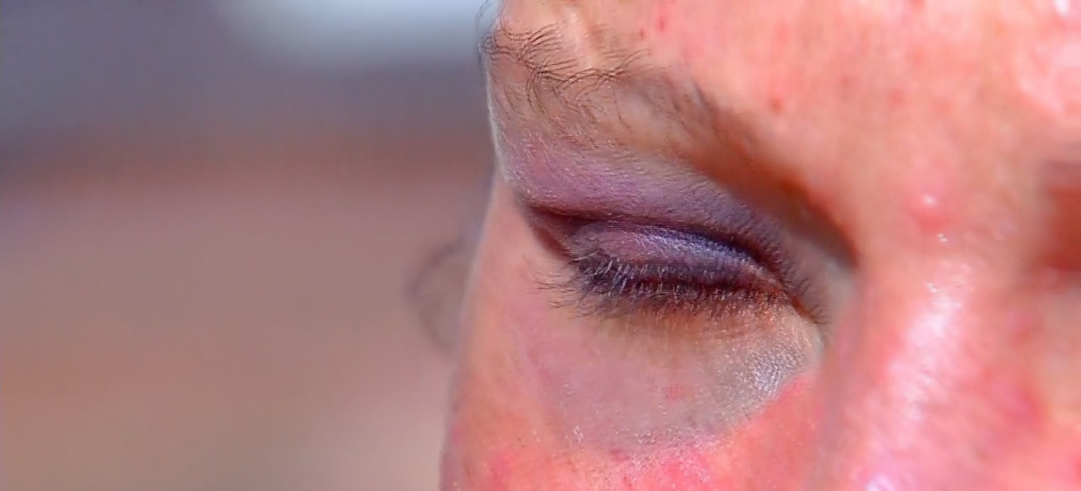Mulher que esfaqueou marido ao ser agredida est com o olho roxo e o rosto praticamente todo machucado  Foto: TV Centro Amrica