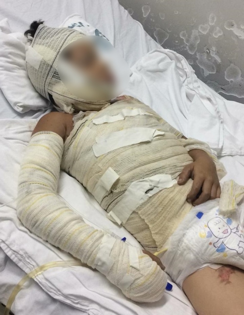 Menino, de 8 anos, teve alta mdica aps ter 45% do corpo queimado  Foto: Arquivo pessoal