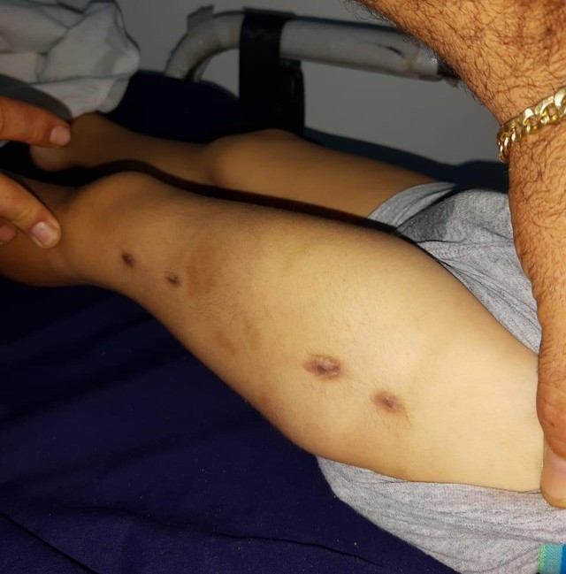 Hematomas no corpo de criana espancada  Foto: Arquivo pessoal