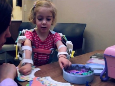 Emma, com 2 anos, consegue brincar e levar doces  boca graas ao WREX