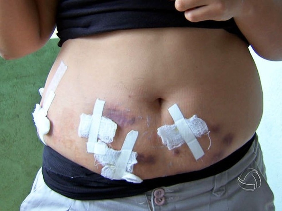 Paciente contou que tratamento gerou diversas feridas na barriga — Foto: Reprodução/TVCA