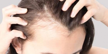 Perda de cabelo ps Covid-19 atinge um a cada quatro infectados