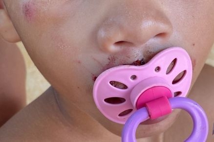 A criana foi levada para o hospital para receber curativos