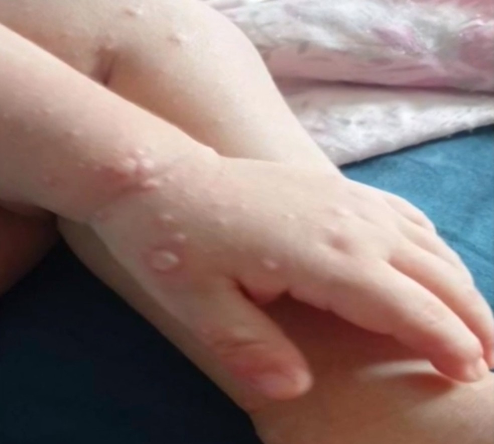 Sade emite comunicado de surto de doena mo-p-boca  Foto: Reproduo/Rede Amaznica Acre