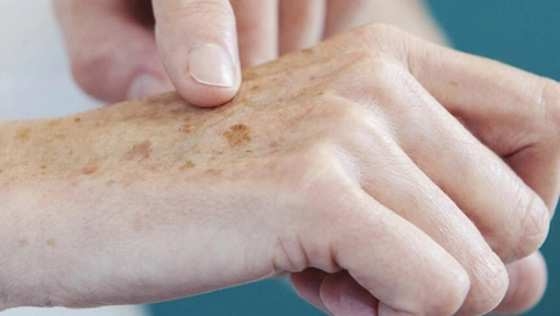 Exames para detectar cncer de pele caem 43% em MT