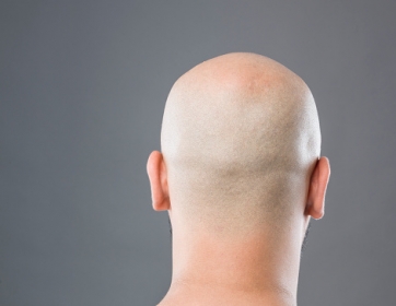 Justia britnica decide que homem chamado de careca foi vtima de assdio sexual