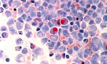 Cncer de crebro: Previso de 140 novos casos este ano em Mato Grosso