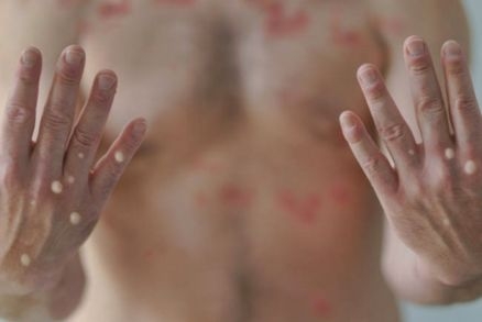 Sade cita novos casos em Cuiab e VG e MT chega a 8 infectados