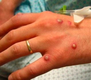 Em caso de suspeita, a pessoa deve procurar ajuda mdica e realizar isolamento imediato