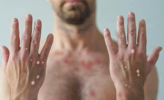 Leses na pele se desenvolvem primeiramente no rosto e, depois, se espalham para outras partes do corpo, incluindo, as genitais