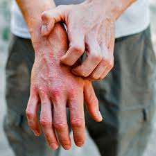 Mato Grosso ficou em segundo com maior nmero de casos novos na populao geral, com 1.778 diagnsticos