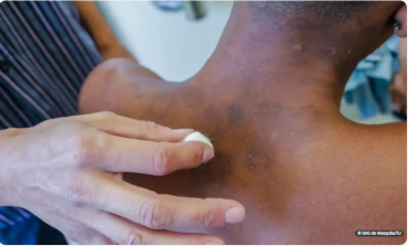 Neste ano, s�o 4.348 diagn�sticos da hansen�ase, n�meros que t�m chamado a aten��o das autoridades p�blicas