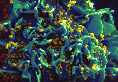 Para esclarecer: o termo HIV  usado para se referir ao vrus da imunodeficincia humana. J AIDS significa sndrome da imunodeficincia adquirida. Ou seja, HIV  um vrus e AIDS  uma sndrome que pode ser desenvolvida por pessoas portadoras desse v