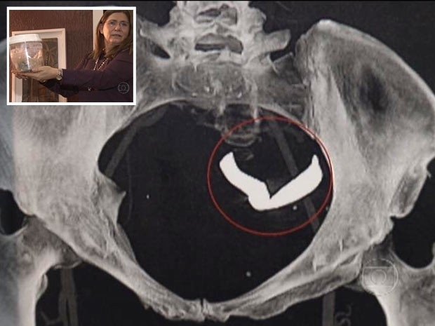 Imagem mostra material esquecido no abdmen da servidora Rosilane do Carmo Rocha