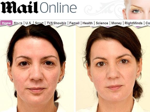 Aps um ms, as manchas no rosto sumiram e ela perdeu 1 kg Foto: Reproduo