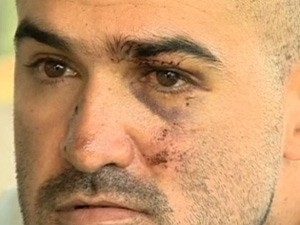 Rorion perdeu 6 dentes, levou 16 pontos na cabea e nove na plpebra