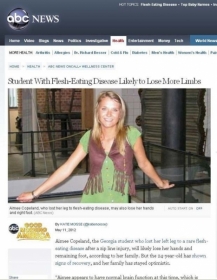 Aimee Copeland sofre com doen�a chamada fasce�te necrotizante (Foto: Reprodu��o/ABC) (Foto: Reprodu��o/ABC)