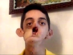 Rapaz ficou com rosto deformado aps cncer.