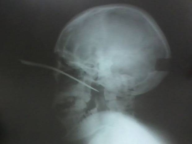 A faca atravessou o olho esquerdo do jovem e ficou presa na cabea.