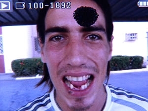 Argentino teve o dente quebrado e alega ter sido espancado por policiais.