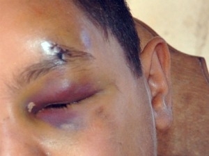 Polcia investiga caso de aluno que teria sido agredido em escola