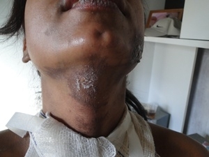 Foli� teve ferimentos no pesco�o, bra�o, peito e cabe�a.