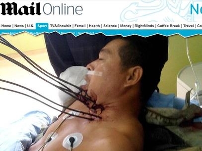 O homem foi submetido a uma cirurgia por seis horas para remover as barras