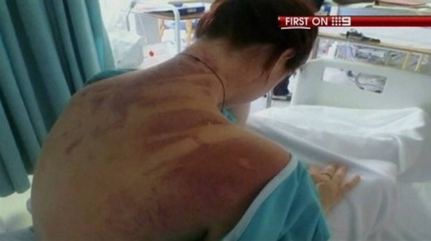 Erin Laung Worth mostra escoriaes nas costas.