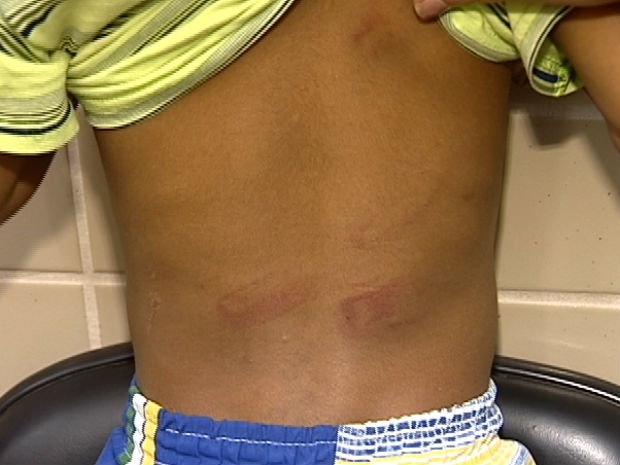 Marcas da agresso nas costas da criana