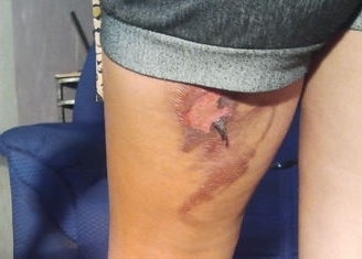 Gilmara sofreu queimaduras na perna durante o parto do filho Nicolas.