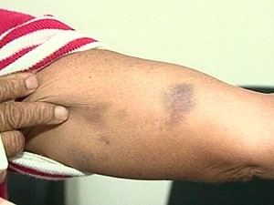 Mulher mostra marcas de agresso no corpo