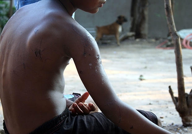 Me diz que garoto ficou traumatizado com o ataque do cachorro