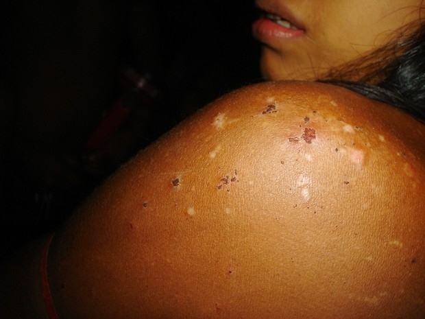 Pesquisadores notam ndios com mordidas de baratas