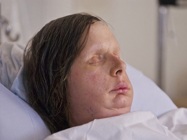 Charla Nash logo aps a cirurgia que reconstruiu a sua face.